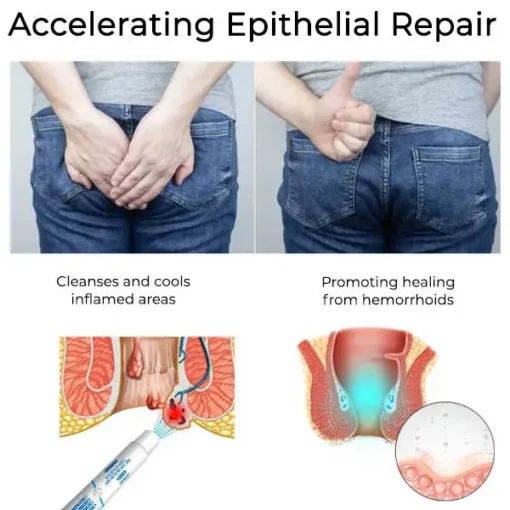 LOVILDS® Herbal Hemorrhoid Treatment Anal Spray Pro