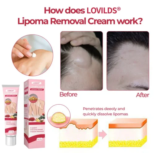 LOVILDS® LumpCure Lipoma Cream