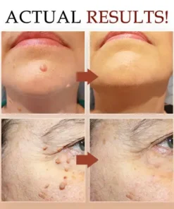 LOVILDS™ Non-Invasive Mole and Wart Removal Pen