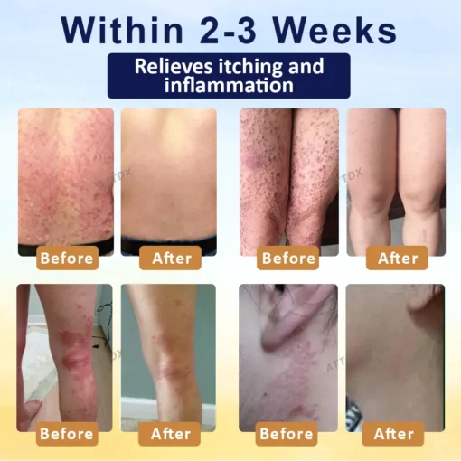 LOVILDS® Psoriasis Care Mellifera Venom Skin Healing Spray