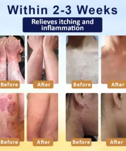 LOVILDS® Psoriasis Care Mellifera Venom Skin Healing Spray