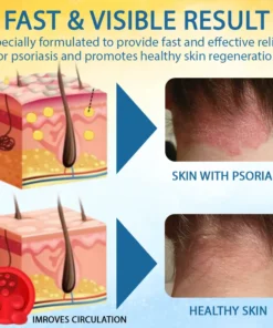 LOVILDS® Psoriasis Care Mellifera Venom Skin Healing Spray