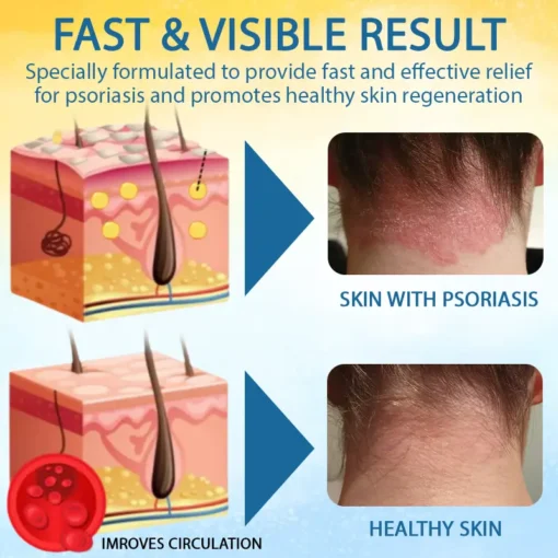 LOVILDS® Psoriasis Care Mellifera Venom Skin Healing Spray