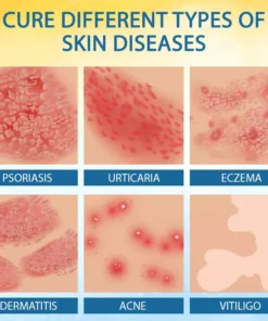 LOVILDS® Psoriasis Care Mellifera Venom Skin Healing Spray