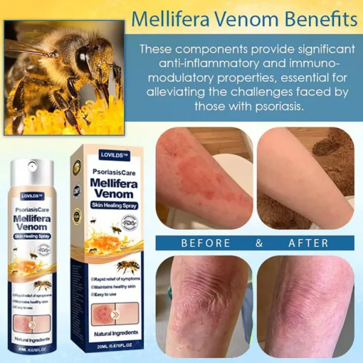 LOVILDS® Psoriasis Care Mellifera Venom Skin Healing Spray