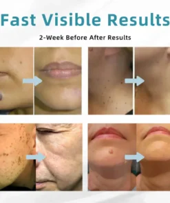 LOVILDS® VelvetSkin+ All-in-One Laser Eraser Pen