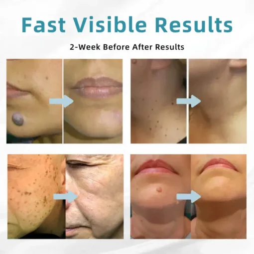 LOVILDS® VelvetSkin+ All-in-One Laser Eraser Pen