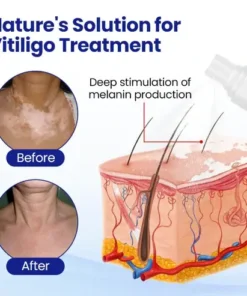 Lovilds® Evenora Vitiligo Herbal Spray