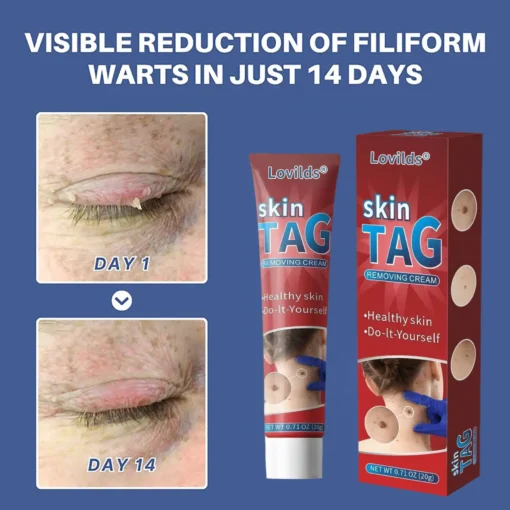 Lovilds® HPV Facial Filiform Warts Removal Cream
