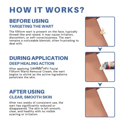 Lovilds® HPV Facial Filiform Warts Removal Cream