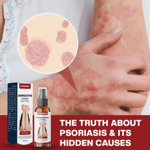 LOVILDS® DermSoothe Psoriasis Relief Spray
