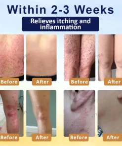 LOVILDS™ Psoriasis Care Mellifera Venom Skin Healing Spray