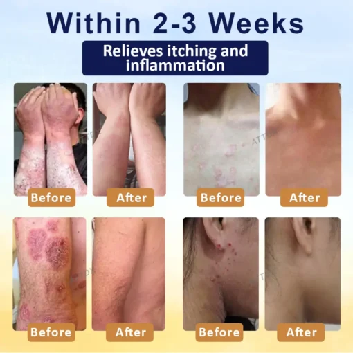 LOVILDS™ Psoriasis Care Mellifera Venom Skin Healing Spray