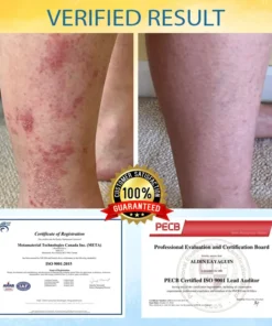 LOVILDS™ Psoriasis Care Mellifera Venom Skin Healing Spray