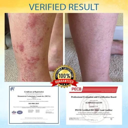 LOVILDS™ Psoriasis Care Mellifera Venom Skin Healing Spray