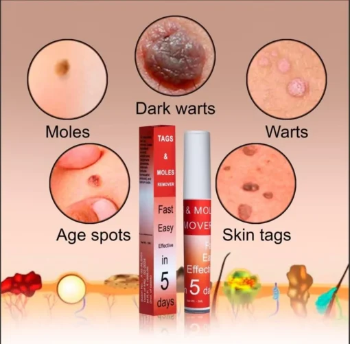 LOVILDS™ Tags & Moles Remover