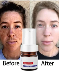 LOVILDS™ WHITENING ANDFRECKLE REMOVING ESSENCE