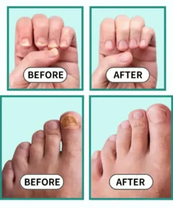LOVILDS™Fast, Painless Nail Fungus Treatment with Blue Light Technology