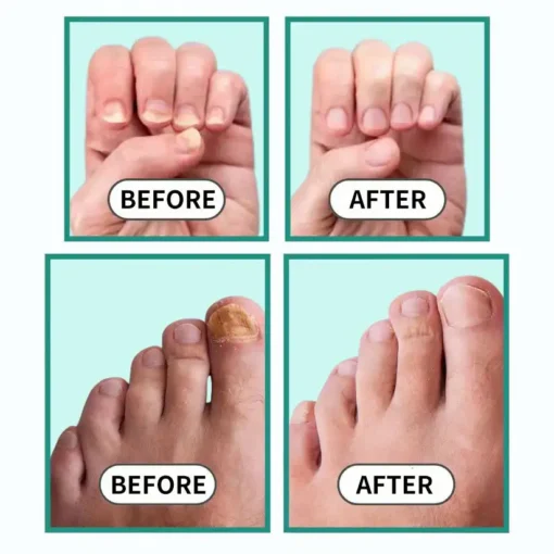 LOVILDS™Fast, Painless Nail Fungus Treatment with Blue Light Technology