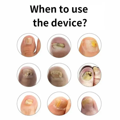 LOVILDS™Fast, Painless Nail Fungus Treatment with Blue Light Technology