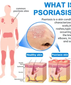 Lovilds® Magnesium Herbal Psoriasis Spray