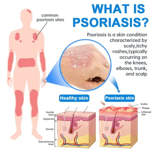 Lovilds® Magnesium Herbal Psoriasis Spray