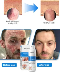 Lovilds® Magnesium Herbal Psoriasis Spray