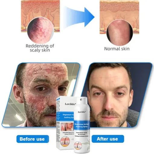 Lovilds® Magnesium Herbal Psoriasis Spray