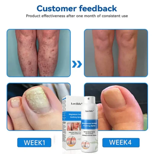 Lovilds® Magnesium Herbal Psoriasis Spray