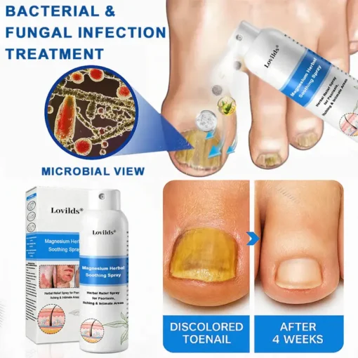Lovilds® Magnesium Herbal Psoriasis Spray