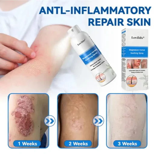 Lovilds® Magnesium Herbal Psoriasis Spray