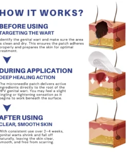 LOVILDS® Microneedle Patch — Effective for All Types of HPV Warts