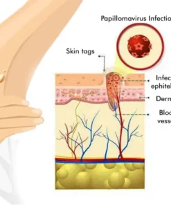 LOVILDS™ Warts & Tags Remover