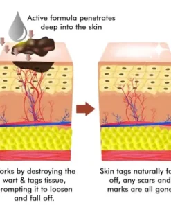 LOVILDS™ Warts & Tags Remover