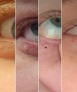 LOVILDS® – Skin Wart & Skin Tag Removal Kit