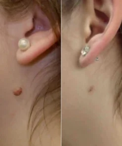 LOVILDS® – Skin Wart & Skin Tag Removal Kit