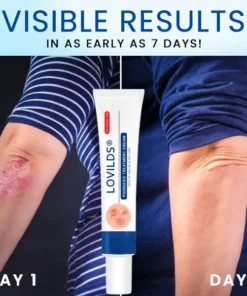 LOVILDS™ Psoriasis Treatment Cream