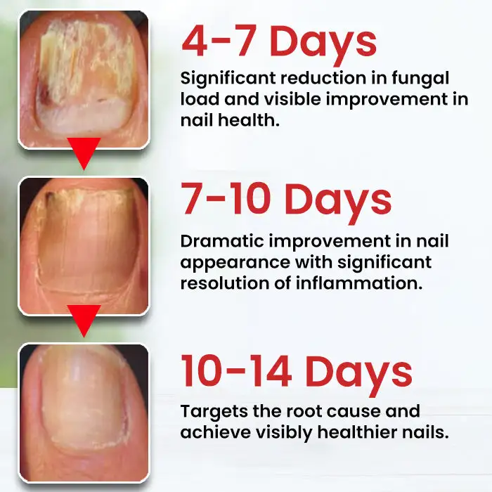 LOVILDS™ Fungi-Cure Max Fast-Acting Relief for Fungal Nail Infections
