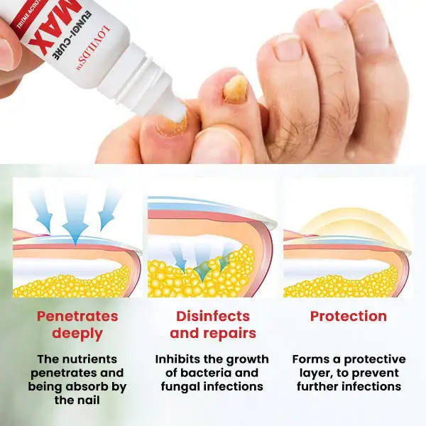 LOVILDS™ Fungi-Cure Max Fast-Acting Relief for Fungal Nail Infections