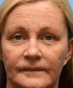 Lovilds® Botin Vita-A Retinol Shot Wrinkle-Lift Tightening cream - Last Day Promotion 70 OFF