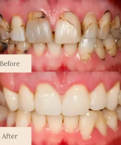 LOVILDS™ Advanced Enamel Repair & Whitening Kit