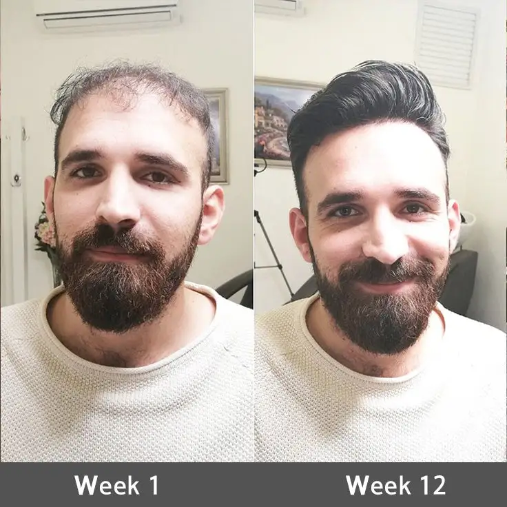 LOVILDS® Highly Effective Biotin & Rosemary Hair Growth Serum