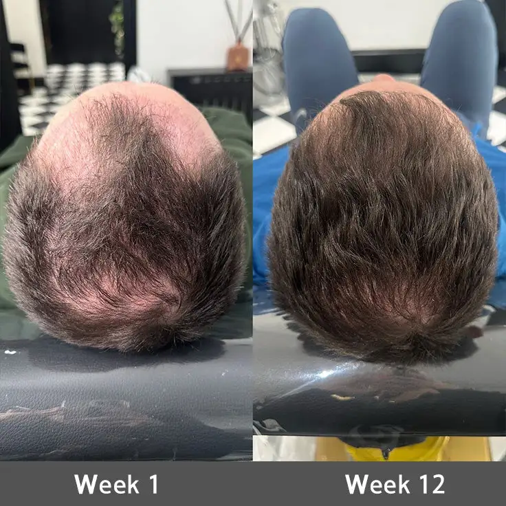 LOVILDS® Highly Effective Biotin & Rosemary Hair Growth Serum