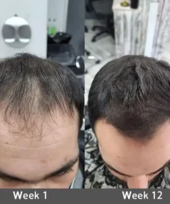 LOVILDS® Highly Effective Biotin & Rosemary Hair Growth Serum