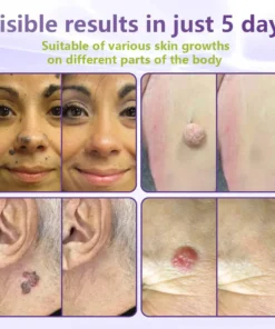 LOVILDS™ SOLUBLE MICRONEEDLE BOTANICAL SKIN TAG REMOVAL PATCH