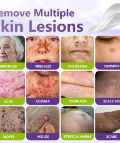 LOVILDS™ SOLUBLE MICRONEEDLE BOTANICAL SKIN TAG REMOVAL PATCH